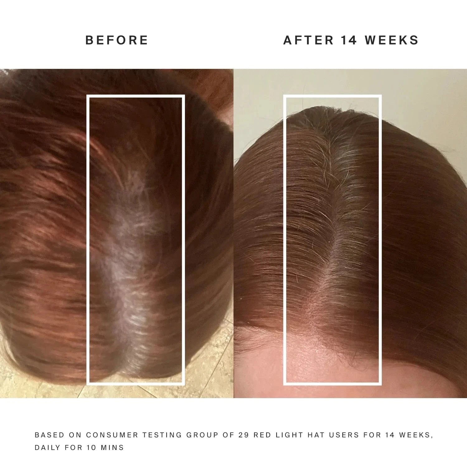 Discover the Red Light Therapy Hat, a safe home treatment promoting hair growth. Strengthen follicles with 650nm light for fuller hair in just 10 minutes daily.