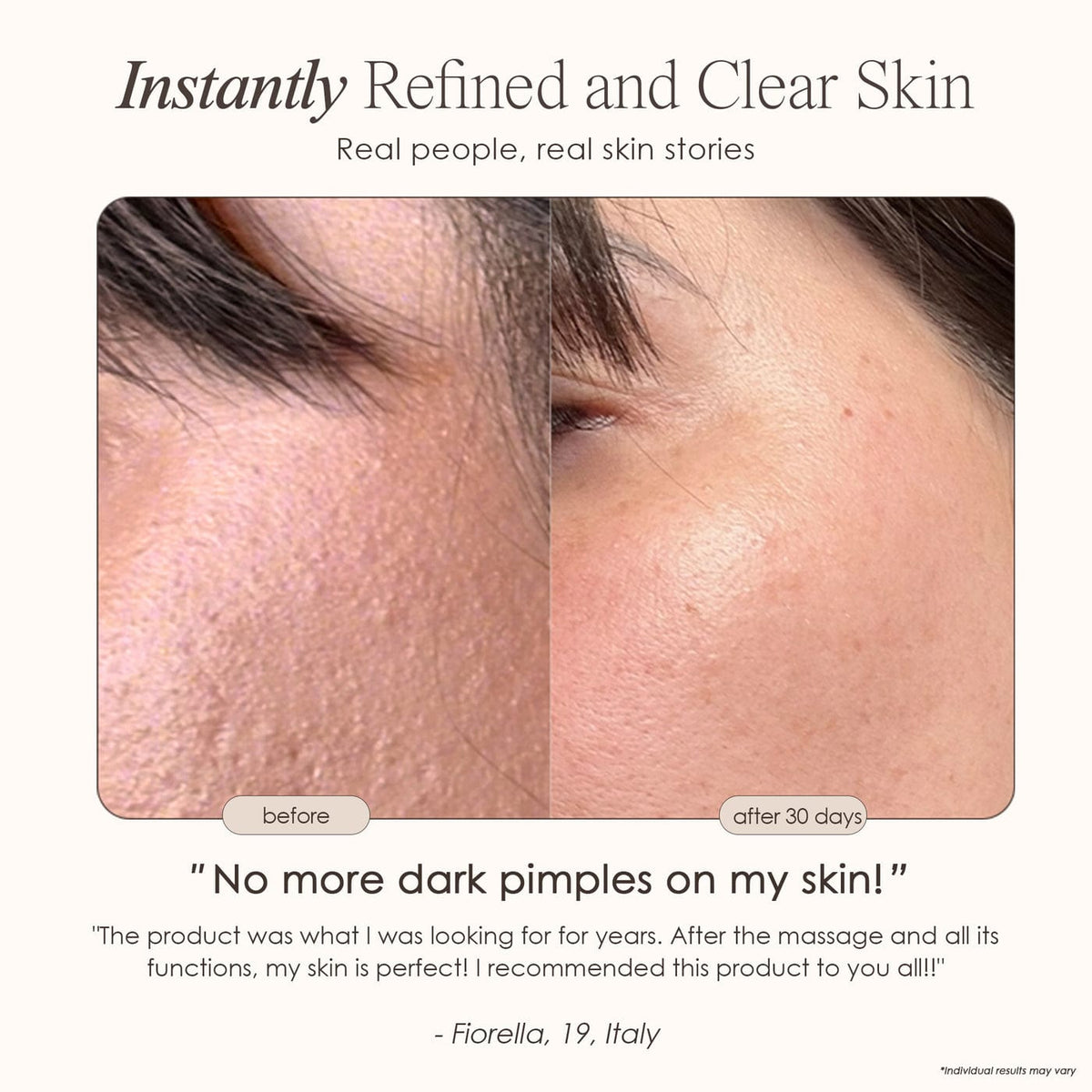 Shop the Reinvo Facial Microdermabrasion Wand for spa-quality exfoliation at home. Reduce fine lines, clear pores & boost skincare absorption fast.