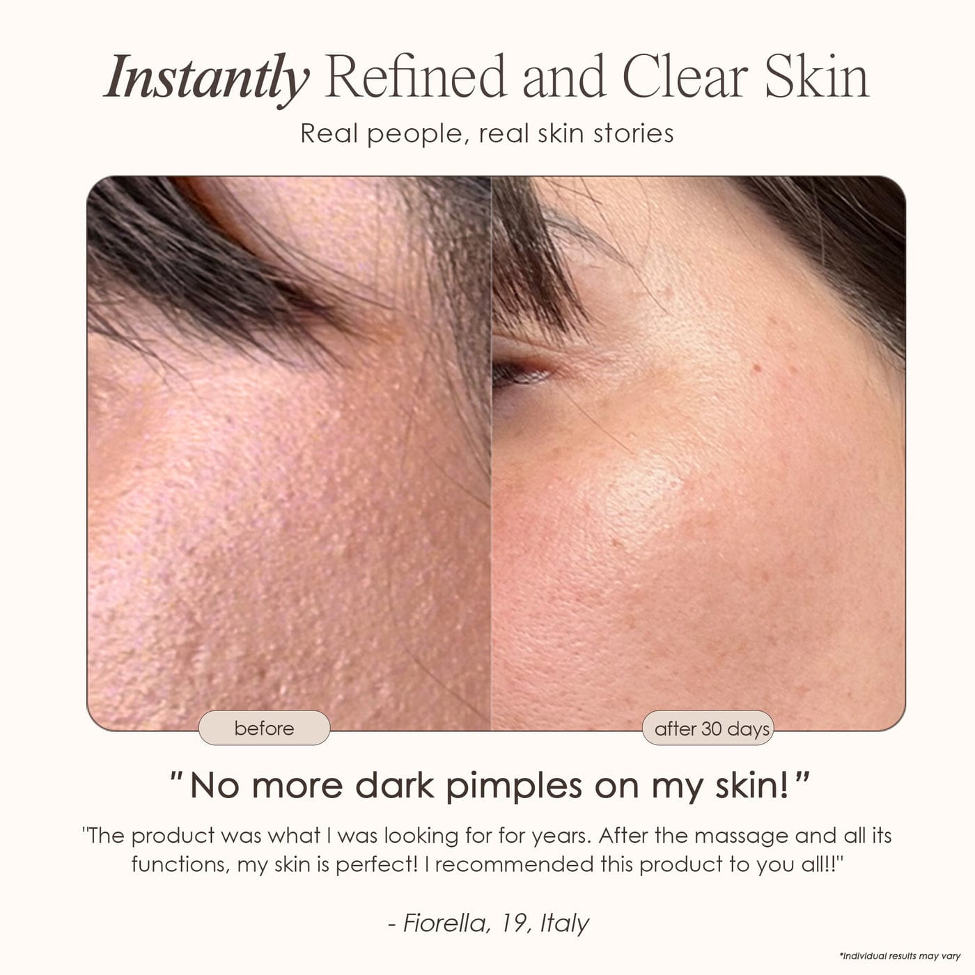 Shop the Reinvo Facial Microdermabrasion Wand for spa-quality exfoliation at home. Reduce fine lines, clear pores & boost skincare absorption fast.