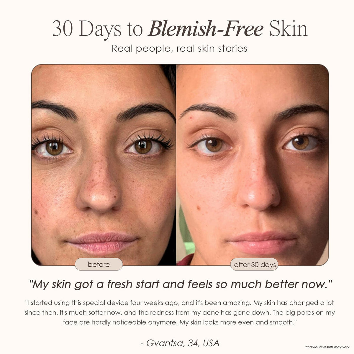 Shop the Reinvo Facial Microdermabrasion Wand for spa-quality exfoliation at home. Reduce fine lines, clear pores & boost skincare absorption fast.